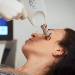 TRATAMIENTO DE LÁSER FACIAL TÉCNICO
